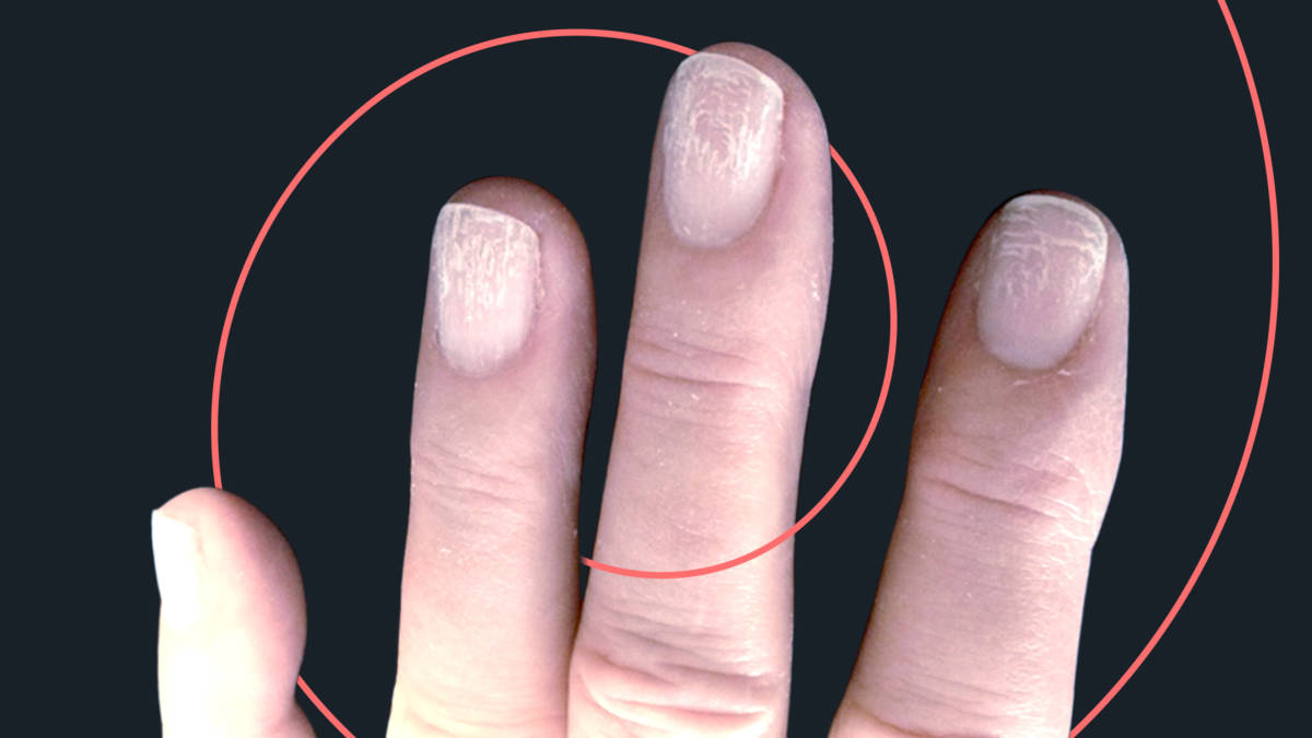 Schimmels, infecties en ander prutswerk nagelbranche wil amateurs weren NOS