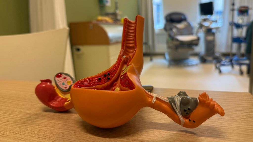 Foto: Gynaecologen onderzoeken nieuwe pijnbehandeling bij endometriose